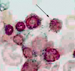 photomicrograph of ring sideroblasts